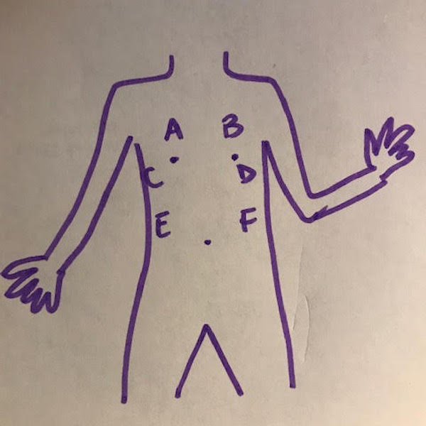 A drawing of a torso with different areas labelled from A to F where a port can be on the body.